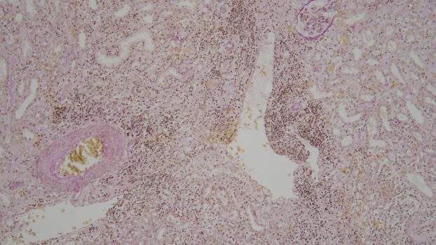 PROMICAM HDMI 22 - pyelonephritis