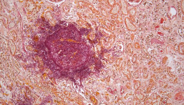 PROMICAM PRO 3-16CP - kidney