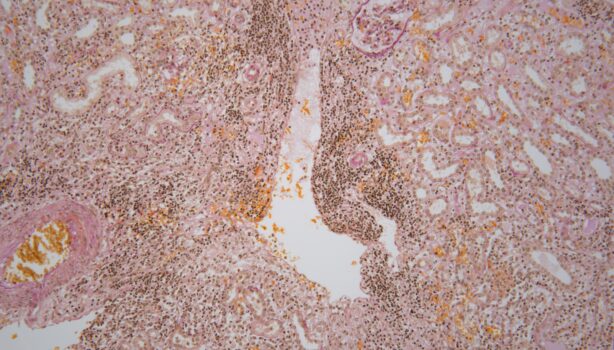 PROMICAM PRO 3-16CP - pyelonephtitis