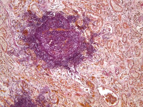 PROMICAM PRO L5 - kidney