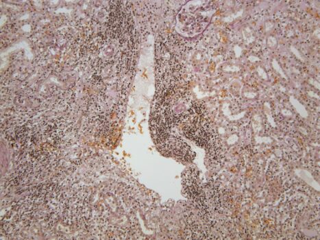 PROMICAM PRO L5 - pyelonephiris